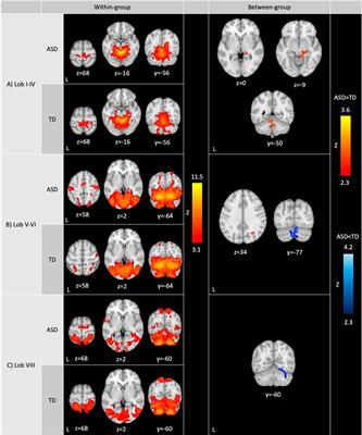 Functional connectivity of the sensorimotor cerebellum in autism: associations with sensory over-responsivity